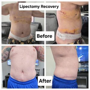 Lymphatic drainage