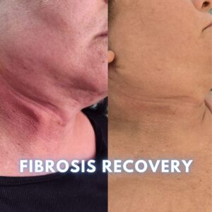 Fibrosis recovery result